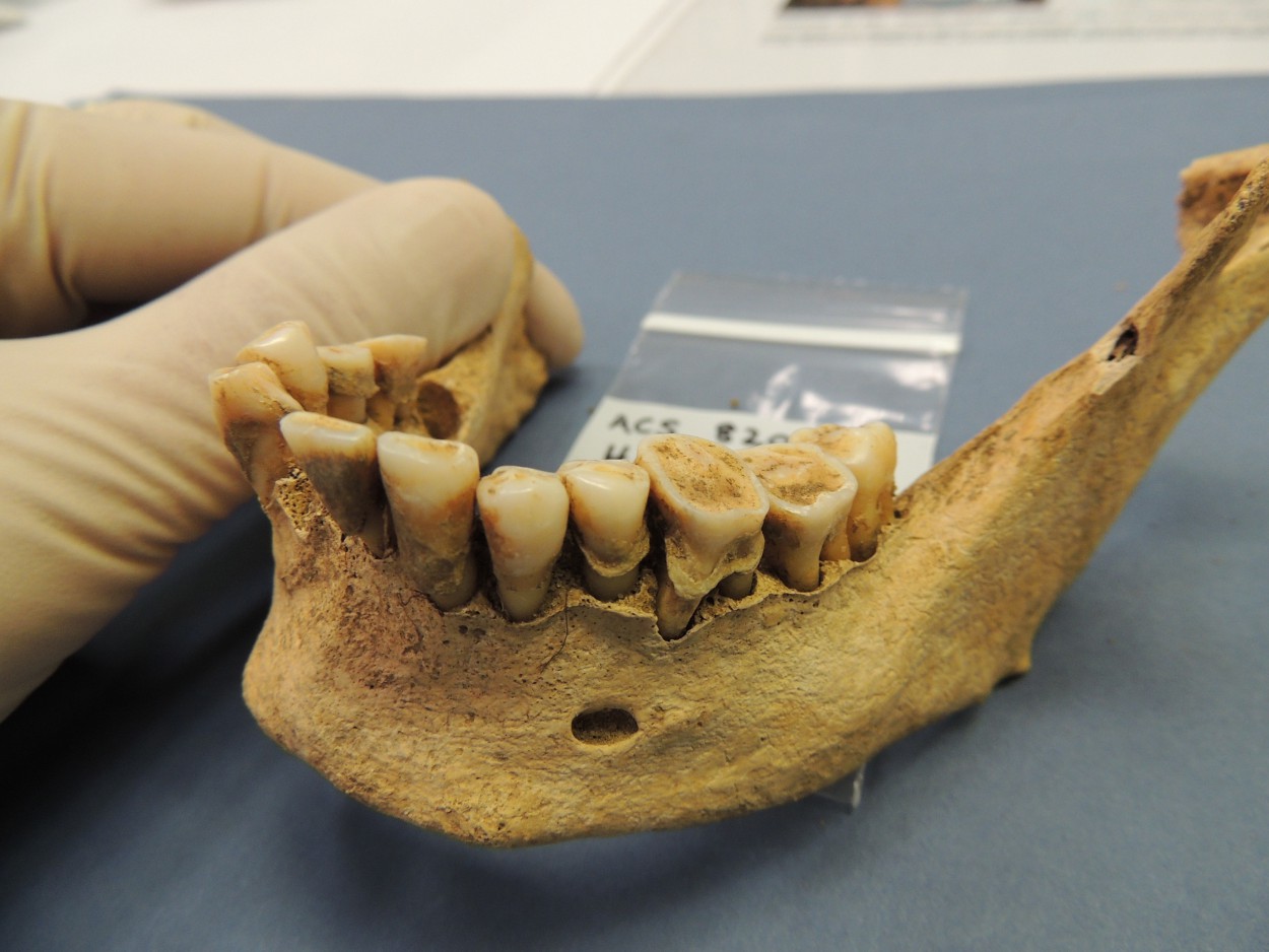 Зубные протезы древнего Рима