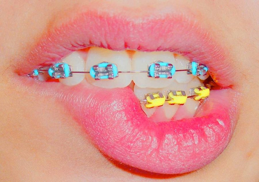 Разноцветные брекеты на зубах фото