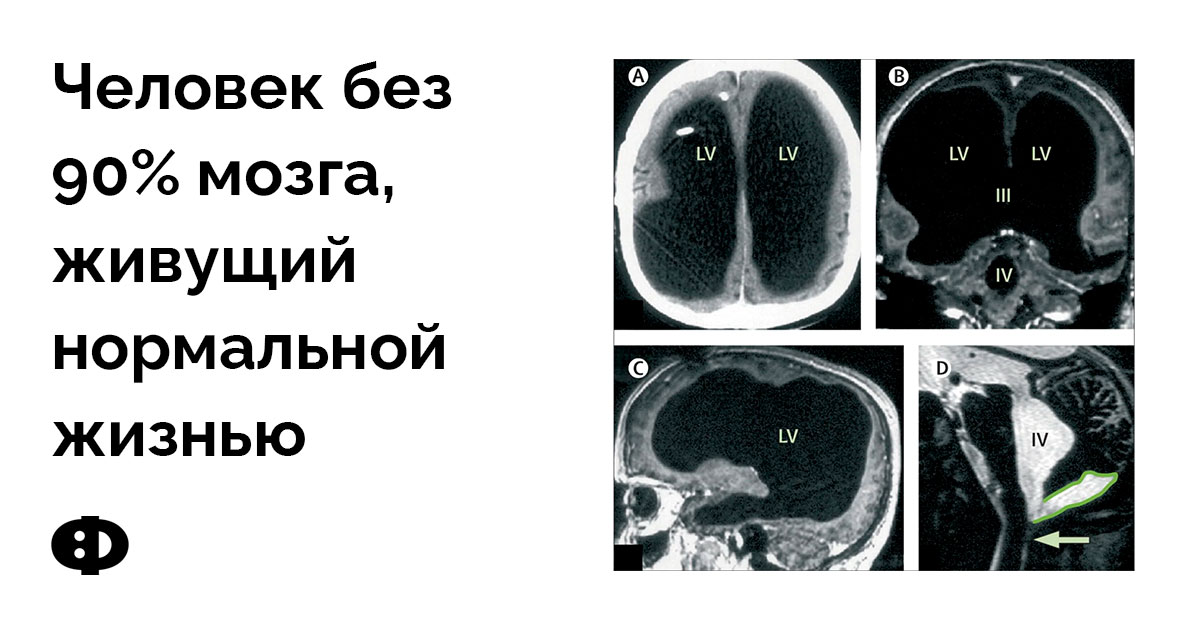 сколько человек живет без мозга